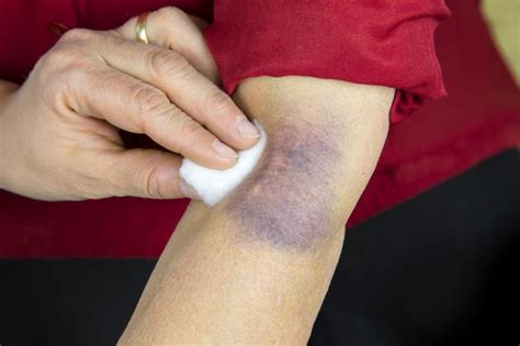 Bruise: Types, Symptoms, Causes, Prevention & Treatment