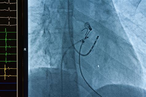 Cardiac Ablation — Hurstville Private Heart Centre · Cardiology · South ...