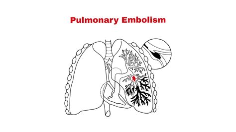 Pulmonary Embolism ~ Chest Pain