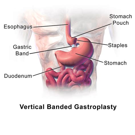 Vertical banded gastroplasty surgery - Wikiwand