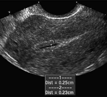 Endometrial measurement in the presence of fluid | Medical ultrasound, Obstetric ultrasound ...