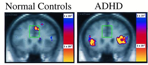 Anterior cingulate cortex dysfunction in attention-deficit ...