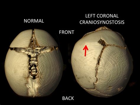 Coronal Synostosis — Dallas Pediatric Plastic Surgeon, Craniofacial Surgeon, Cleft Lip and ...