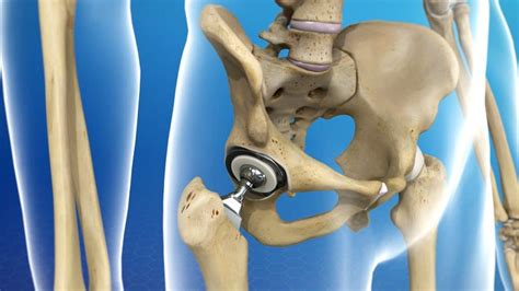 Hip Replacement Facts You May Not Know – Palmetto Bone & Joint Blog