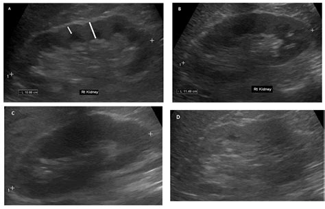 Diagnostics | Free Full-Text | Ultrasound Renal Score to Predict the Renal Disease Prognosis in ...