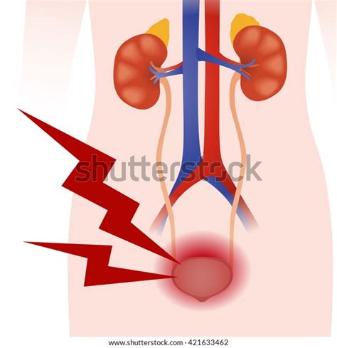 7 Bladder Neck Obstruction Royalty-Free Images, Stock Photos & Pictures ...