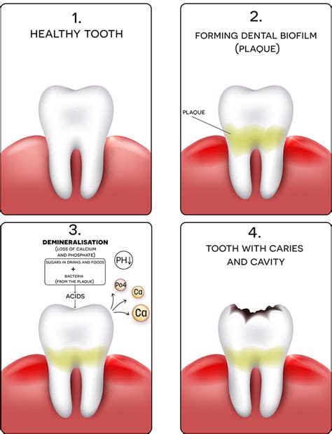 Cavities: Symptoms, Causes, and Treatment - Willow Pass Dental Care