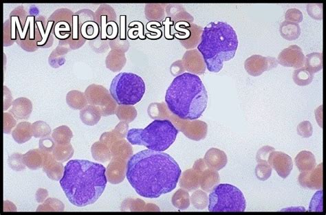 Acute Myeloid Leukemia - Ask Hematologist | Understand Hematology