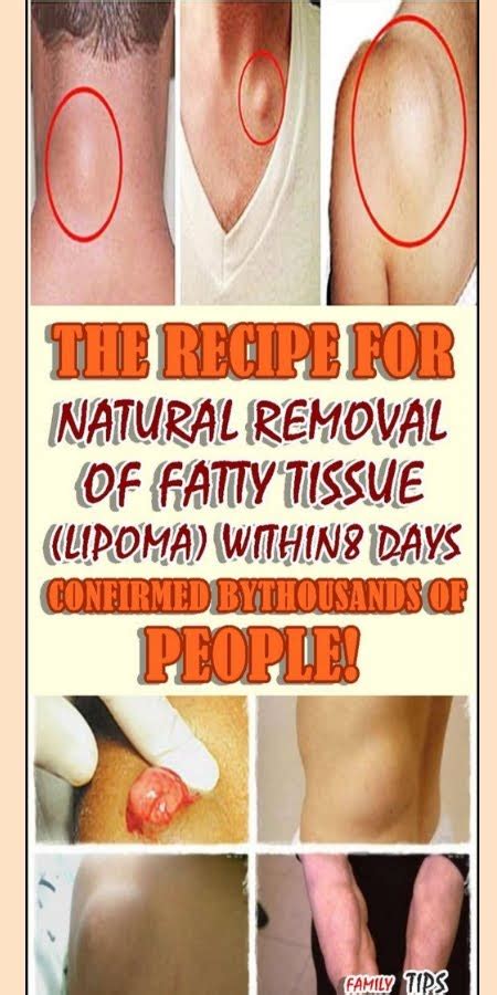 OKHOMOL: THE RECIPE FOR NATURAL REMOVAL OF FATTY TISSUE (LIPOMA ...