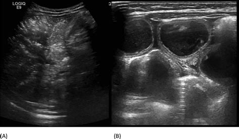 -An abdominal ultrasound demonstrates a significant burden of portal... | Download Scientific ...