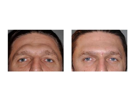 » Blog ArchiveCase Study: Reduction of Prominent Brow Bones in Men