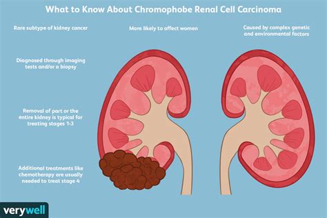 How To Cure Kidney Cancer - Internaljapan9