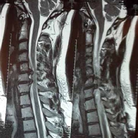 Cervical MRI; (A) Axial T2weighted MRI at C5-C6 level showing left ...