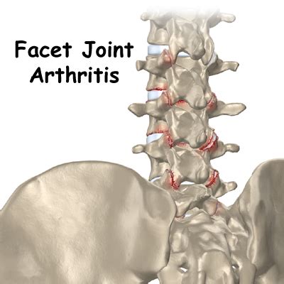 Facet Joint Arthritis (Spondylarthritis) in Singapore | Orthopaedic Clinic Singapore