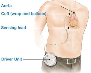 Dr. Wes: A New LVAD Device Begins Early Testing