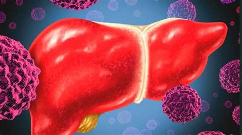 Chemoembolization of the liver: indications, preparation for the procedure, algorithm of ...