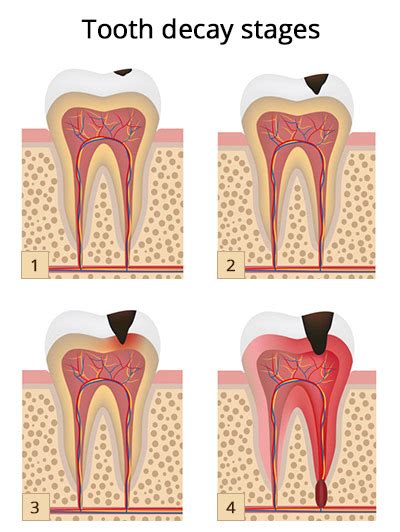 Throbbing Tooth Pain After Filling | Tooth Sensitivity