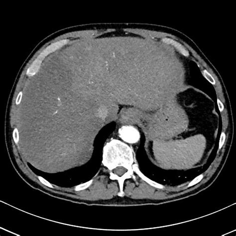 File:Chronic appendicitis complicated by appendicular abscess, pylephlebitis and liver abscess ...