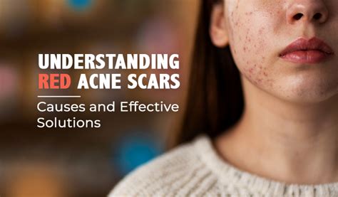 Understanding Red Acne Scars: Causes and Solutions | Acne Wiki