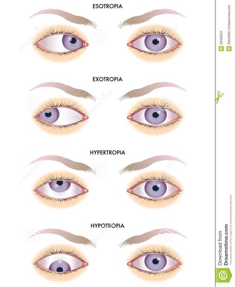 Strabismus - Download From Over 45 Million High Quality Stock Photos, Images, Vectors. Sign up ...