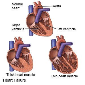 Heart Failure - What You Need to Know