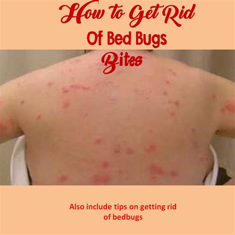 How to Get Rid Of Bed Bug Bites - Online Pest Control