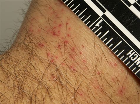 Bed bug bites visible hours after feeding | Bed bugs will cr… | Flickr