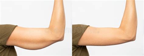 Before and after Excess Skin Removal Under the Arm Stock Image - Image ...