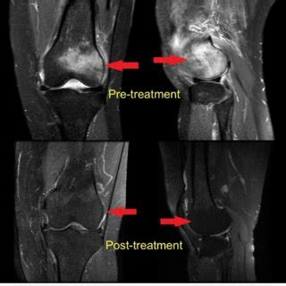 MRI appearance of bone marrow edema of the lateral femoral condyle (arrows) | Download ...