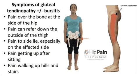 Gluteal Tendinopathy (GTPS) Symptoms and Diagnosis +/- Trochanteric Bursitis: Do I have this?