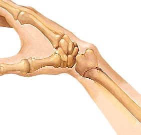 Wrist Fracture | Symptoms & Treatment | Spine & Orthopedic Center