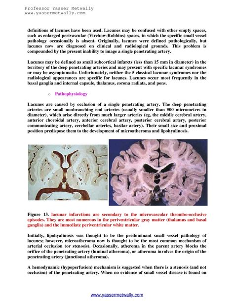 Radiological pathology of ischemic microvascular brain disease…An upd…