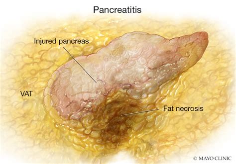 Examining the role of visceral fat in worsening inflammation, organ failure and reduced survival ...