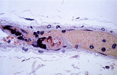 Free picture: nipah virus, infection, case, affecting, human, patient