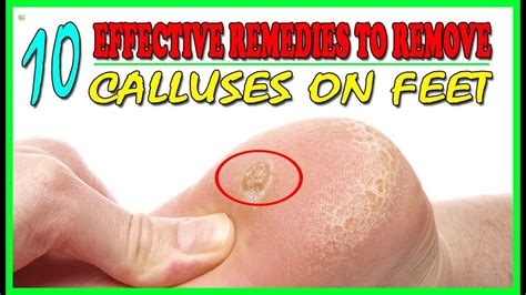 10 Effective Home Remedies To Remove Calluses On Feet - Callus Removal ...