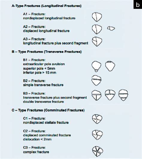 Patella Fracture Case Presentation