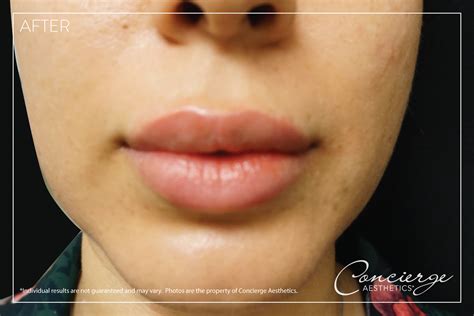 Before and After - Juvederm Volbella - Lips (29 yo) Concierge Aesthetics