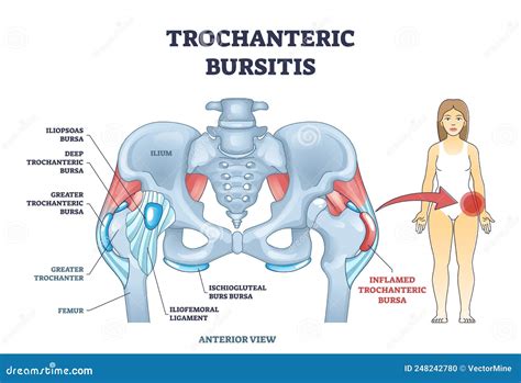 Trochanteric Bursitis As Bursa Inflammation Located in Hip Outline Diagram Stock Vector ...