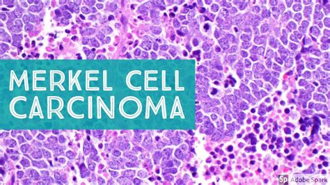 Merkel Cell Carcinoma 101 (primary cutaneous neuroendocrine carcinoma ...