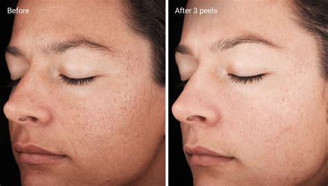 Chemical Peels for Acne Scars: Efficacy, Before and Afters, At-Home Uses