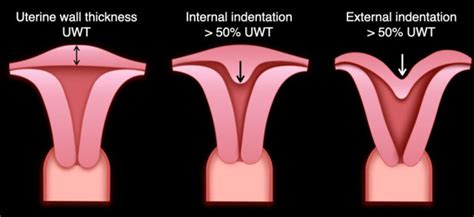 The Radiology Assistant : Müllerian duct anomalies