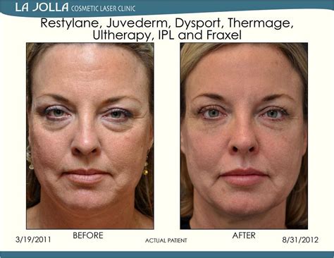 Juvéderm® & restylane® | Proskin Clinics