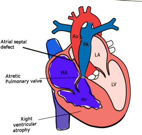 Pulmonary Atresia