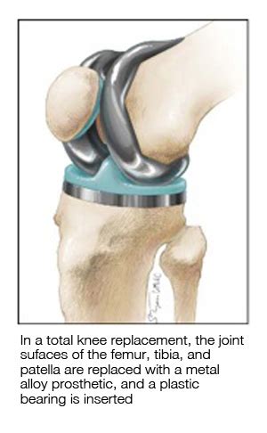 Types of Knee Surgery | Dr. Sonny Bal, MD JD PhD MBA