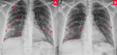 The Role of Chest X-Ray in Monitoring Lung Changes among COVID-19 Patients in Gaza Strip