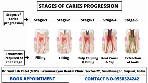 Tooth Decay Stages and How to Treat Each? - Laxmi Narayan Multispeciality Dental Clinic