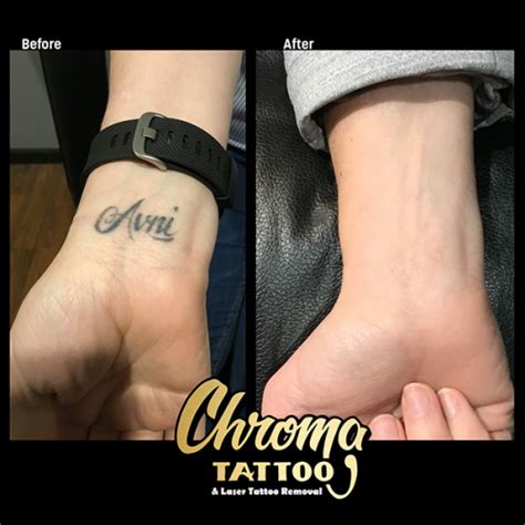 Laser Tattoo Removal in West Bloomfield - Affordable | Chroma Tattoo