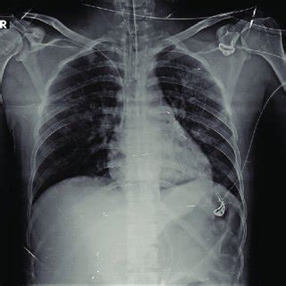 (PDF) Neurogenic Pulmonary Edema in Traumatic Brain Injury