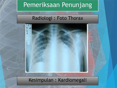 Penyakit jantung rematik