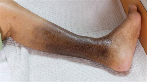 Leg Skin Discoloration Brown Spot